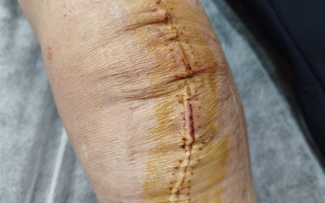 Prótesis de rodilla: guía sencilla para entender la cirugía y la recuperación
